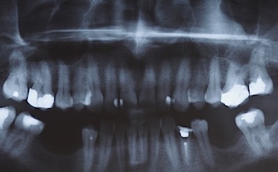 xray of missing teeth