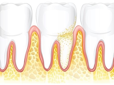 gum disease